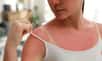 La tendance « Burn lines » est dangereuse pour la santé. © New Africa, Adobe Stock